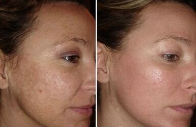 Rajeunissement de la peau du visage au laser photos avant et après