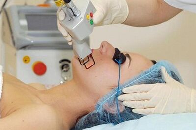 Types de rajeunissement de la peau du visage au laser